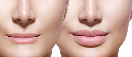 Lips Fillers