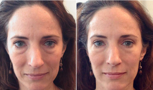 Face Lift Massages for Wrinkles